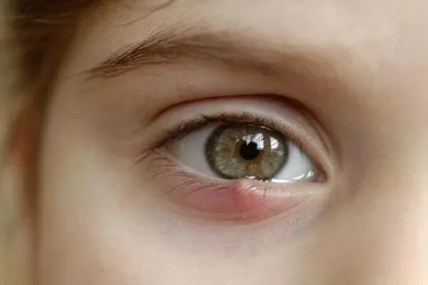 How can I get rid of a stye asap