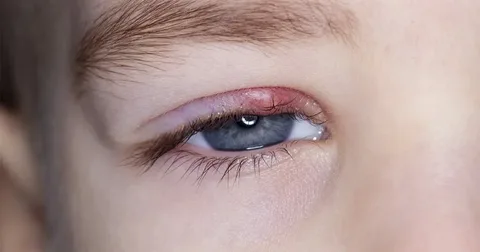 How can I get rid of a stye asap