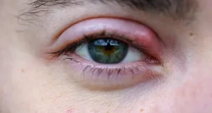 How can I get rid of a stye asap