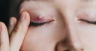 4 Types of Eyelid Bumps: Understanding, Causes, and Treatments